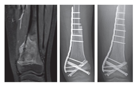 수술 이전 환자의 MRI 사진(왼쪽) 종양이 발생했음을 확인할 수 있다.수술 직후(가운데)와 수술 후 4년 이후(오른쪽) 환자의 단순방사선사진. 종양을 제거한 부위는 골이식을 통해 개건했다.해당 환자의 무릎관절운동은 완벽하게 정상수준까지 회복됐다.