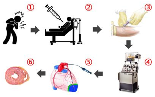 ① 심근경색증이 발생하면 모든 병원에서 응급으로 관동맥 스텐트를 삽입하여 개통시킴. 그 직후에 매직셀-치료법이 시작됨. 즉, ② 골수로부터 말초혈액으로 줄기세포를 이동시키기 위해서 3일에 걸쳐서 G-CSF와 Erythropoietin 이라는 사이토카인을 피하 주사함 ③④ 나흘째 말초혈액에서 줄기세포를 채취함. 혈액성분 채취기계를 이용함 ⑤ 바로 이어서 채취한 줄기세포를 카테타를 이용하여 관동맥을 경유하여 경색심근에 투입함 ⑥ 심근세포 사망을 저지시키면서 경색증후 반흔을 줄이면서, 심부전 발생을 예방하고 환자의 운동능력을 향상시킴