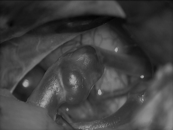 뇌동맥류 사진 (강남세브란스병원)