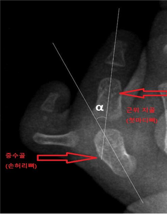 사진 1 중수골-엄지손가락간 각도(MDA) 중수골(손허리뼈)과 엄지의 근위 지골(첫마디뼈)이 이루는 각도를 중수골-엄지손가락간 각도(MDA)라 한다. 해당 각도가 10.8° 이상인 경우, 절골술을 시행하는 것이 예후가 좋은 것으로 나타났다.