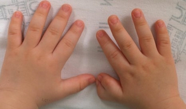 사진 2 다지증 환자의 손.우측 엄지가 2개이다 (출처 : 서울대병원 의학정보)