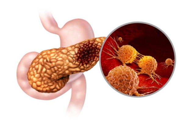 서울대병원 류지곤 교수팀이 췌장암 ‘ERCC6’ 유전자 변이 최초 발견했다. 