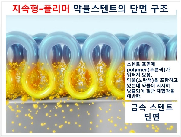 지속형-폴리머 약물스텐트 금속스텐트단면(이미지=서울대병원)