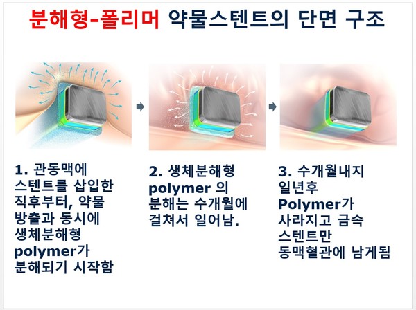 분해형-폴리머 약물스텐트 단면구조 (이미지=서울대병원)