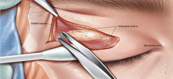 간단한 안검 절개를 통한 내시경 뇌수술 (출처:군자출판사)