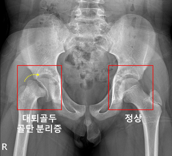 [사진=서울대병원 제공] 우측 고관절에 대퇴골두 골단 분리증이 발생한 소아청소년 환자의 X-ray