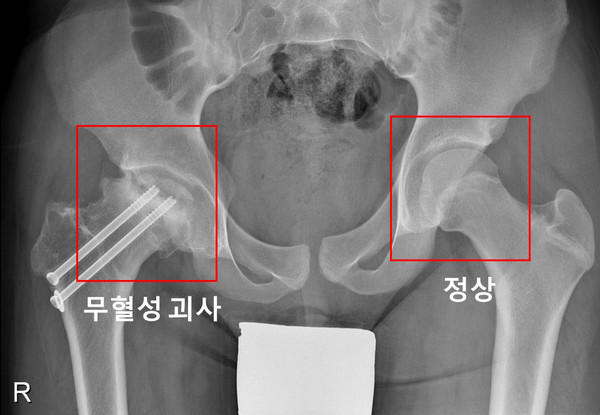 [사진=서울대병원 제공] 우측 고관절에 무혈성 괴사가 발생한 소아청소년 환자의 X-ray