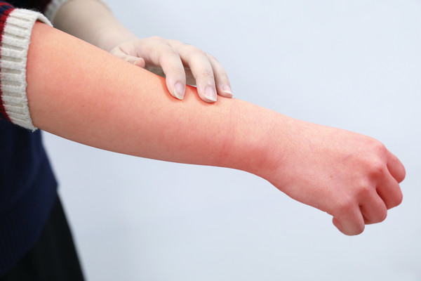 예시 사진(실제 병변은 아님).(사진=고려대안산병원 제공)