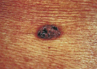 악성흑색점흑색종.