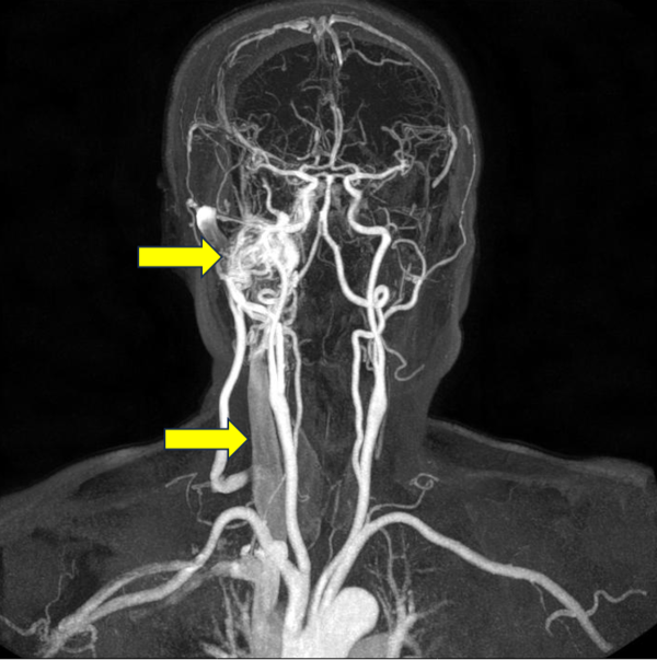 박동성 이명 호소하는 환자의 자기공명 뇌혈관조영 사진.우측 해면 정맥동 부위에 동정맥 누공에 의해 실타래처럼 얽힌 큰 병변이 관찰되고(상부 화살표), 아래쪽으로 내려가는 경부 정맥이 크게 부풀어 있다.(하부 화살표)