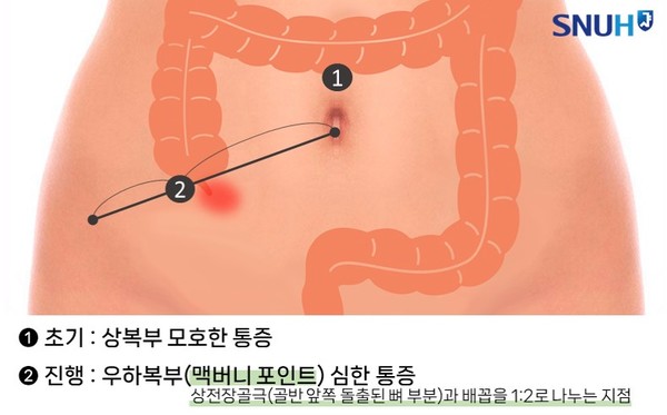 충수염 통증 발생 부위.(사진=서울대병원)