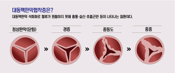 대동맥판막협착증 협착 정도에 따른 중증도 설명.