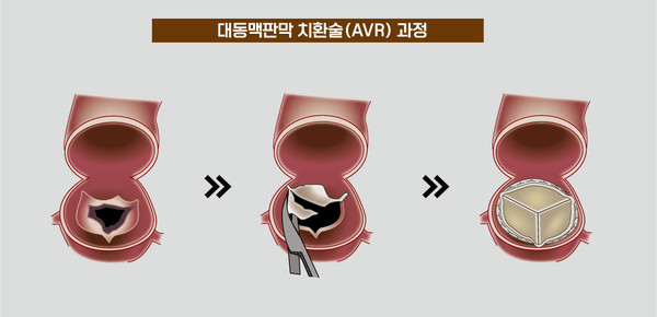 대동맥판막치환술(AVR, Aortic Valve Replacement) 과정.