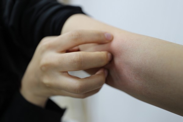 아토피 이미지. (사진=고려대학교 안암병원 제공)