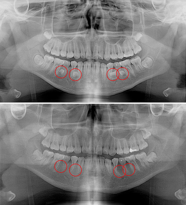 과잉치 수술 전후 비교 사진. 위쪽 수술 전, 아래쪽 수술 후. (사진=고려대학교 안산병원 제공)