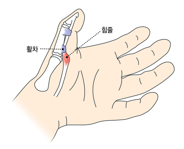방아쇠수지 그래픽. (강동경희대학교병원 제공)