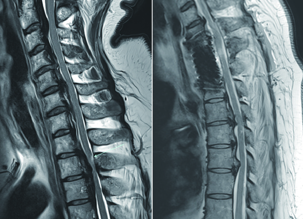 수술 전 석회화된 후종인대와 손상된 척추체(좌), 수술 후 감압된 흉추부 척수와 재건된 척추(우). (사진=순천향대 부천병원 제공)