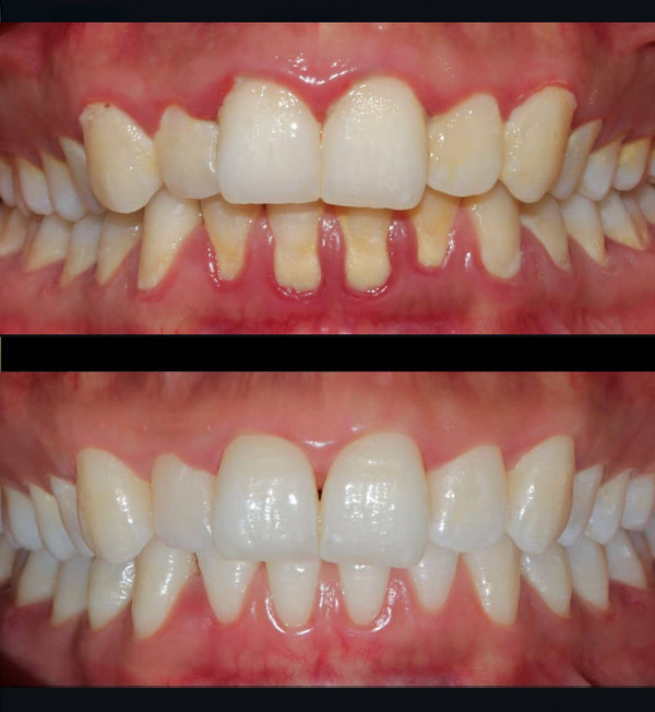 (위아래순) 치주질환 치료 전후 사진. (사진=고대안산병원 제공)